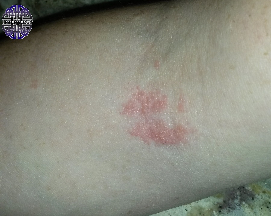 Allergic to Reacting 1